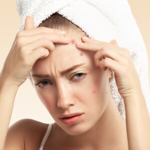 Prevenindo a Acne – Guia Completo para uma Pele Saudável